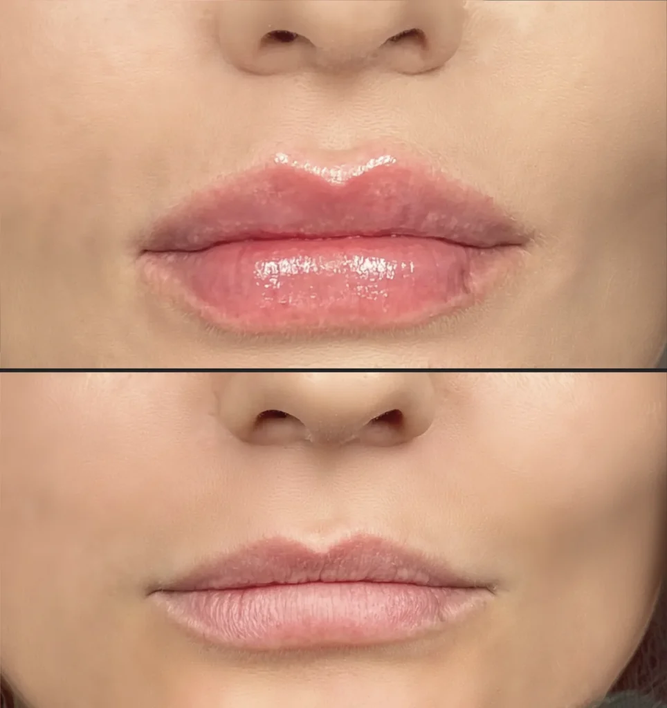 Powiększanie ust Wrocław – bezpieczeństwo w ILLUSTRE
