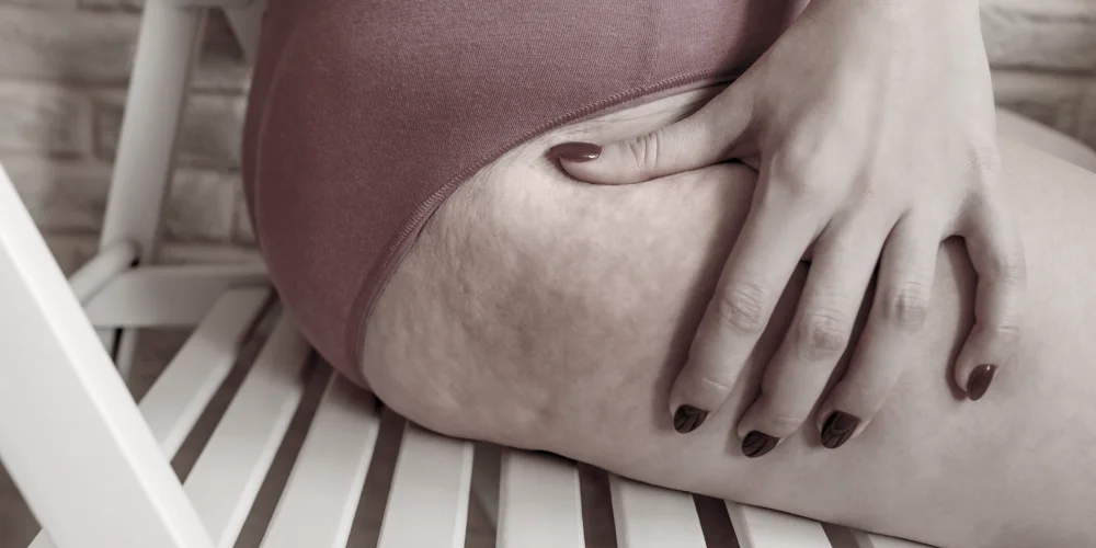 A person sits on a white slatted chair in mauve underwear, one hand resting on their thigh, showing visible cellulite—an issue often addressed at a klinika medycyny estetycznej.