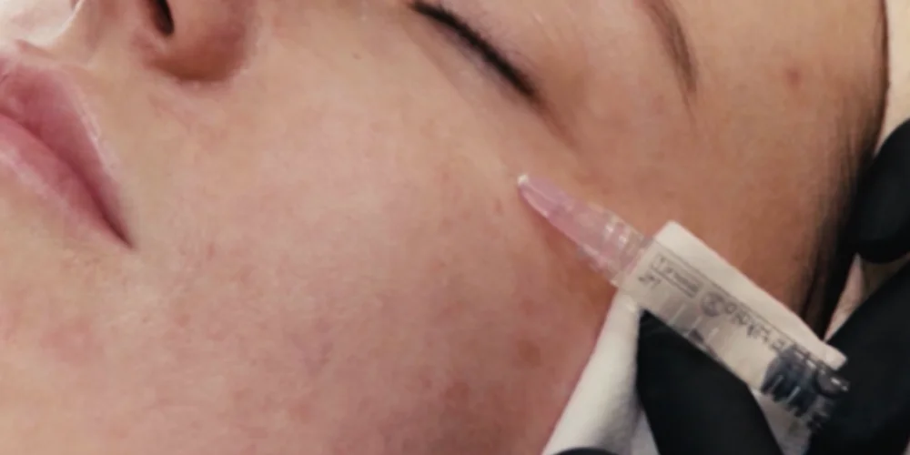 A close-up of a person's face receiving a cosmetic injection near the cheekbone at a klinika medycyny estetycznej, administered by someone wearing black gloves. The person's eyes are closed.