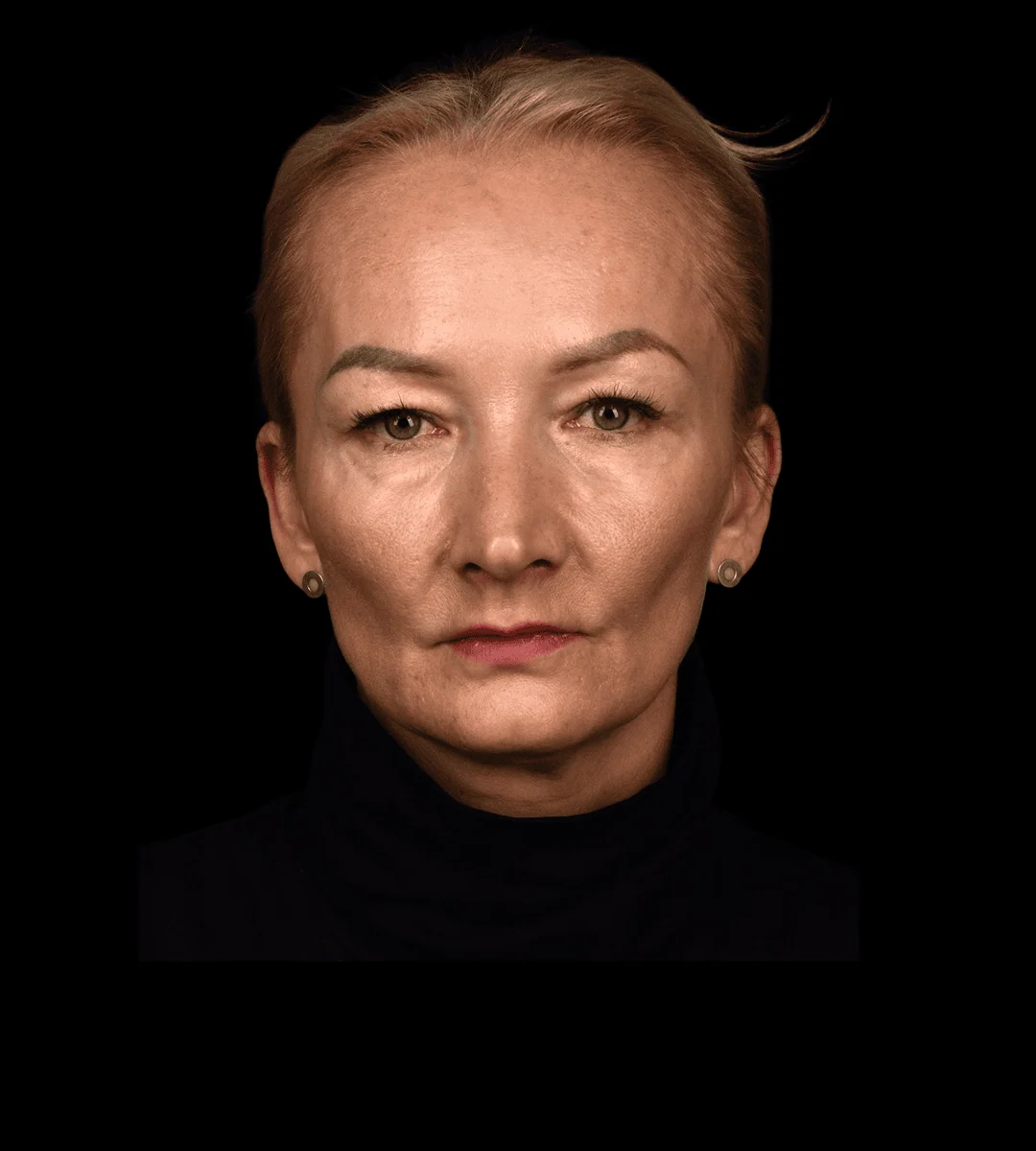 zdjęcis sprzed metamorfozy w klinice Illustre