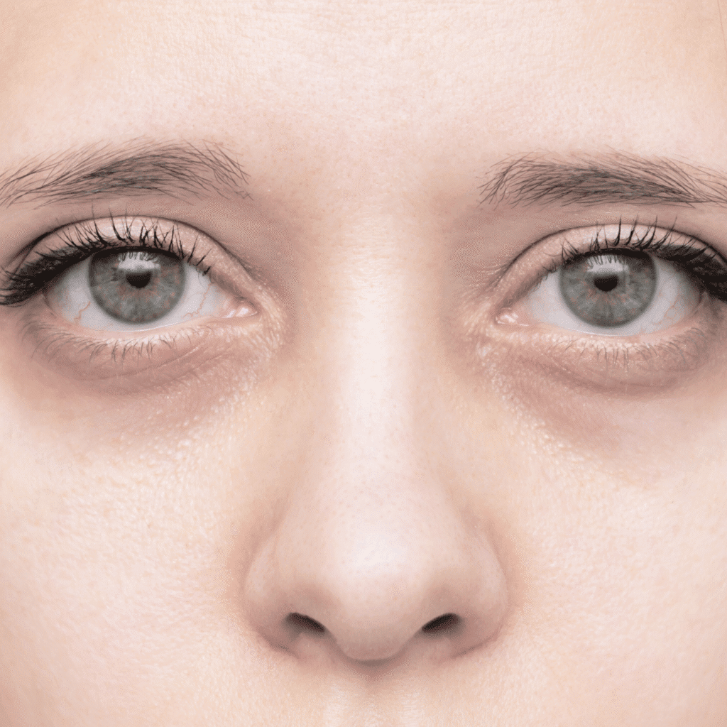 Cienie pod oczami Wrocław – Leczenie | Illustre