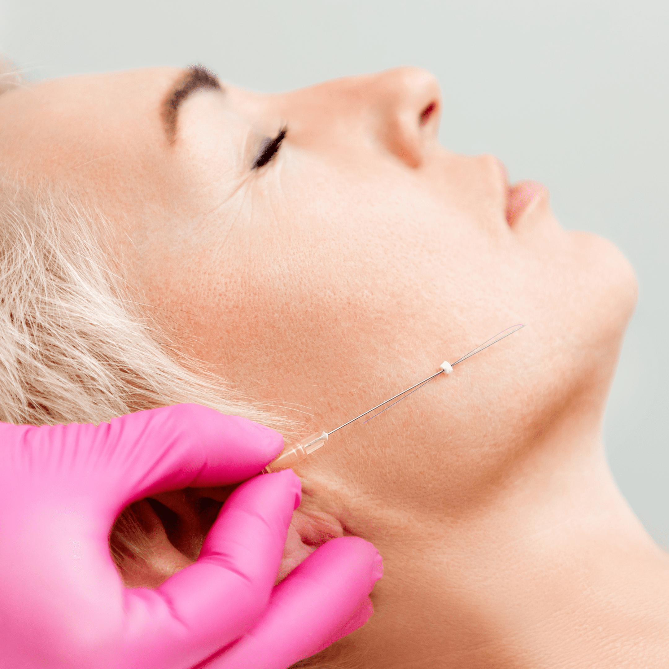 A close-up of a woman’s face as a person wearing pink gloves inserts a thin needle into her cheek, suggesting a medycyna estetyczna Wrocław procedure. The woman appears relaxed with eyes closed during the treatment.